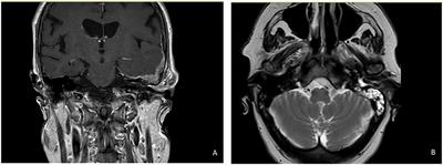 External auditory canal metastasis leading to peripheral facial paralysis as first manifestation of de novo stage IV invasive lobular carcinoma of the breast: a rare case report